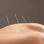 Acupuncture in Michigan